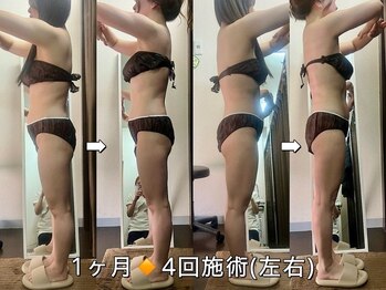 サロンドココ(Salon de COCO)/ハイパーナイフ/全身痩身/美姿勢