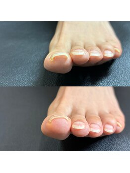 リリ(lili)/巻き爪矯正1回目(左親指)