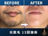 初回限定50%off メンズ光脱毛　全身　髭＋VIO込み　33,000円→16,500円
