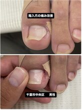 巻き爪じゅん 船橋店/陥入爪がセルフカットで悪化！？