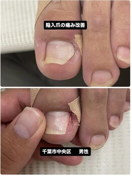 巻き爪じゅん 船橋店/陥入爪がセルフカットで悪化!?