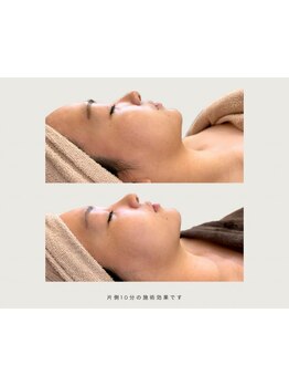 小顔になりたい