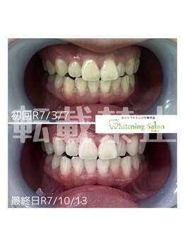 ホワイトニングサロン 札幌店/【ホワイトニング】#札幌#大通り