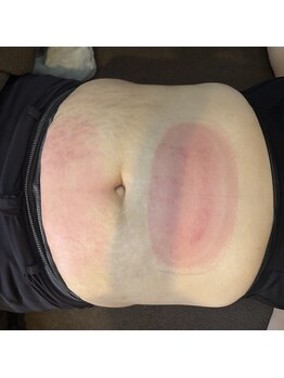 ビーサロン(B-salon)/冷却後の一時的な赤みについて