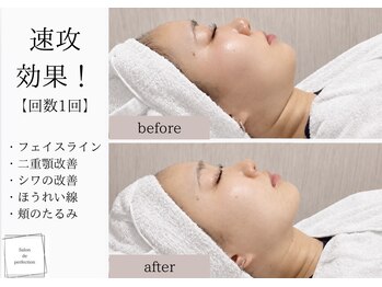 サロン ド パーフェクション(Salon de Perfection)/小顔リフト