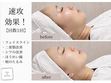サロン ド パーフェクション(Salon de Perfection)/小顔リフト