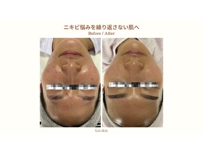 リアスキン(Lia skin)の写真