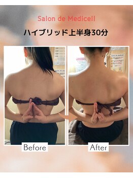 サロン ド メディセル(salon de Medicell)/ハイブリッド上半身ビフォアフ