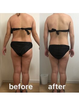 ルフレ(Rufle)/充実コースビフォーアフター