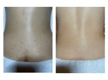 アンクール(esthetic salon uncoeur)/背中ピーリングでニキビケア！！