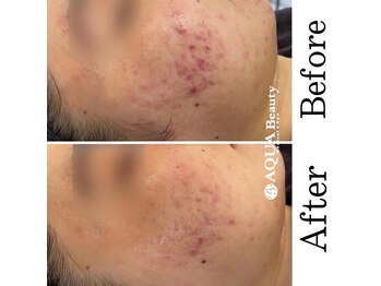 ビーエスアクアビューティー/リベルピーリング