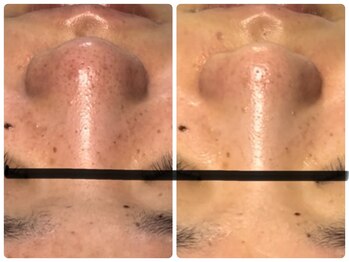 ベルドア(Bell Door)/皮脂/ニキビケア