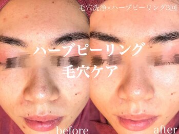 ネオリー(neorii)/毛穴洗浄＋ハーブピーリング