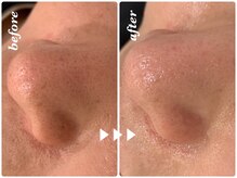 マカオン(machaon)/水素毛穴洗浄