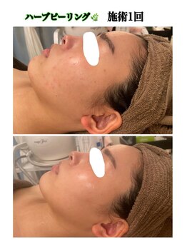 サロンドシェリ(salon de cheri)/ハーブピーリング