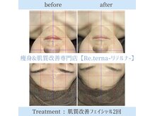 リテルナ(Re.terna)/肌質改善フェイシャル