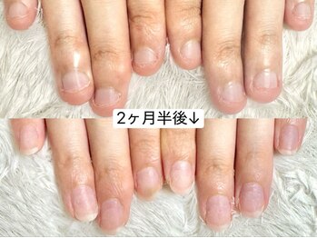 グラシナ なんば店/深爪/自爪育成/フィルイン