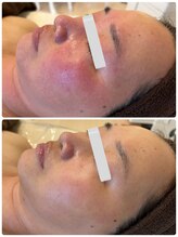 ルミナス(luminous)/赤ら顔改善