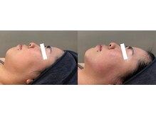 キレイ美肌 北心斎橋店/マイクロウェーブリフト/むくみ