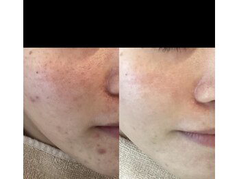 モカ 天王寺店(MOKA)/剥離ハーブピーリングニキビケア