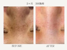 サロンドベル(salon de Belle)の雰囲気（人気沸騰中！！ニキビ、しみ、シワ、毛穴は【プラズマ】が解決☆）