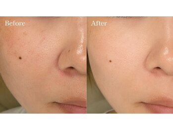 クラティス マヴィ(Clatisse Mavie)の写真/毛穴のケア・ざらつきに☆【フェイシャルWax】で産毛&角質オフ！パッと明るいツルツル素肌へ♪
