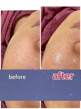 ホナ(HONA)/毛穴にお悩みの方