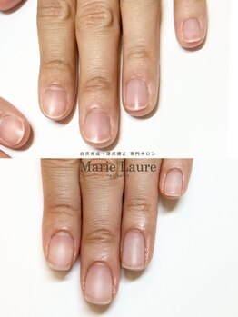 マリーロール 梅田店(Marie Laure)/自爪育成/深爪矯正/ネイルケア