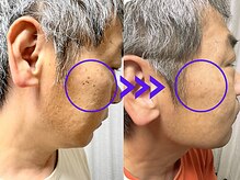 ビュースタイル 梅田 茶屋町店/シミ集中ケア