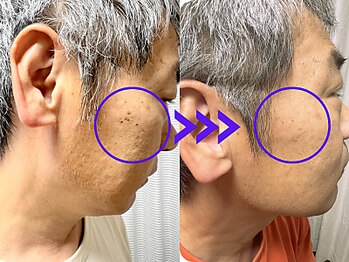 ビュースタイル 梅田 茶屋町店/シミ集中ケア