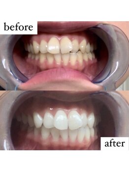 ライトケアサロン 渋谷店(Light Care Salon)/セルフホワイトニング