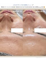 クレヴィー(Creviy)/韓国式3D毛穴洗浄×ハーブ