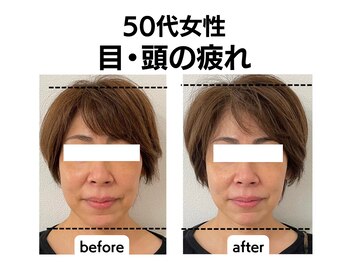 マーキュリー(Mercury)/美容鍼灸+ハーブのお客様