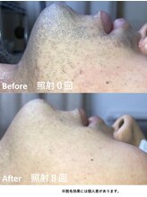 ココリ(CoCoRe)/光脱毛　髭