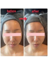 ダリア(Dahlia)/ハーブピーリング