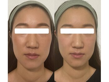 エムズサロン(m’sサロン)/初回1回でのビフォーアフター