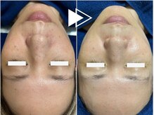 リコ(Ricco)/シミ改善ハーブ★¥9990