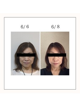 ミヤビ(miyabi)/小顔矯正