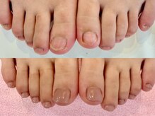 グラシナ なんば店/深爪/自爪育成/フィルイン