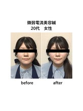 ビハダ(BIHADA)/微弱電流美容鍼　Before/After