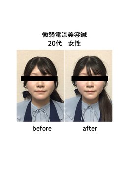 ビハダ(BIHADA)/微弱電流美容鍼　Before/After