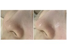 大注目の毛穴洗浄で、毛穴や黒ずみもスッキリ！/毛穴/黒ずみ