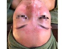 ビューティーメイクさくら/赤ら顔・酒さ