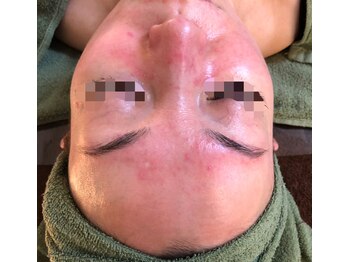 ビューティーメイクさくら/赤ら顔・酒さ