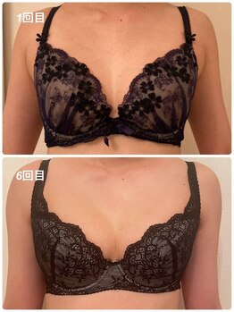 美人バスト 渋谷店/【バストアップ】症例☆20代女性