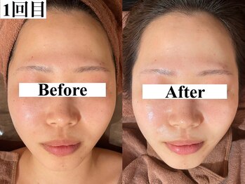 ホワイトアクア 天王寺本店(WHITE AQUA)/ハーブピーリング/大阪/天王寺