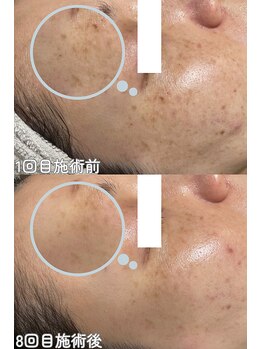 クレアナ ザ ビューティー(KULEANA the beauty)/光フォト+シミ集中ケア+顔脱毛