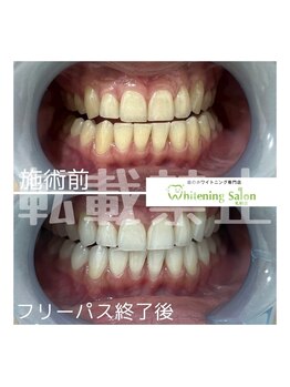ホワイトニングサロン 札幌店/【ホワイトニング】#札幌#大通り