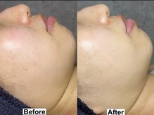 和歌山ララピール&韓国肌管理専門店/ララピール【美白/赤み改善】