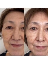 アーネスト 大阪心斎橋店(EARNEST)/韓国式光美容【 目の下しわ 】